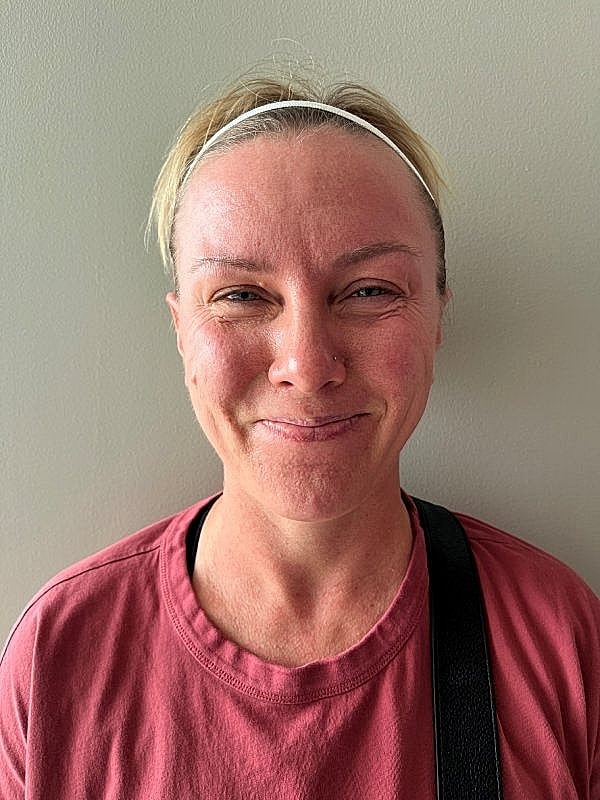 Botox Before & After