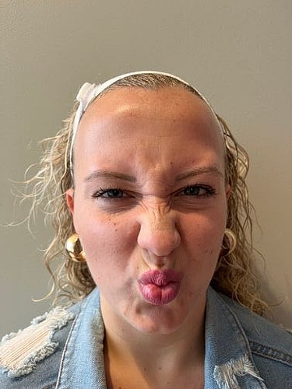 Botox Before & After