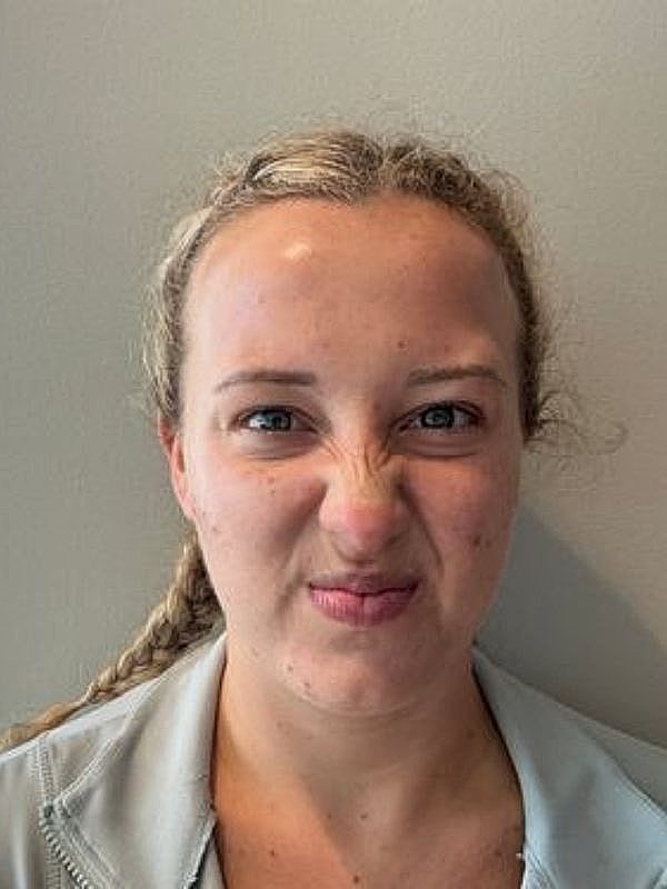 Botox Before & After