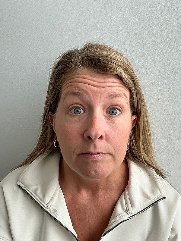 Botox Before & After