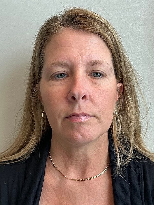 Botox Before & After