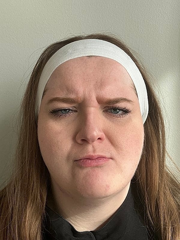 Botox Before & After