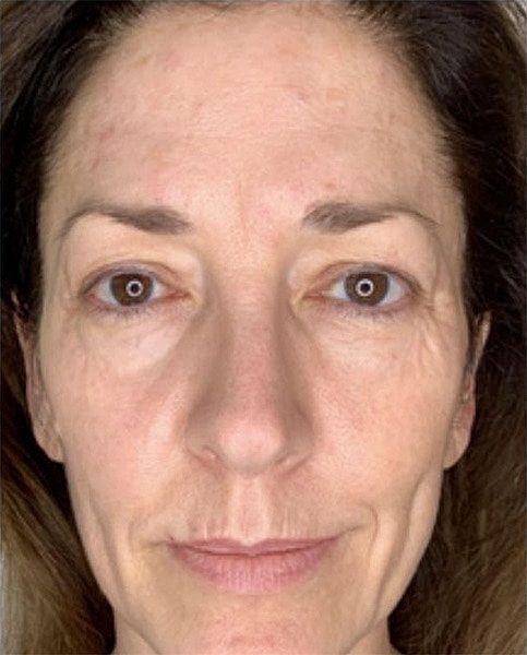 SkinTyte Before & After