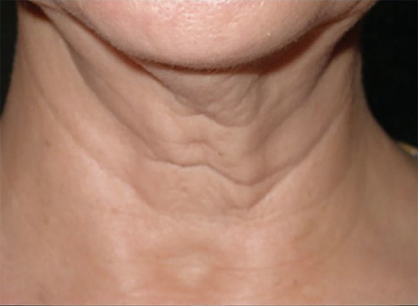 SkinTyte Before & After