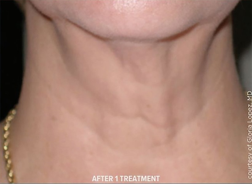 SkinTyte Before & After