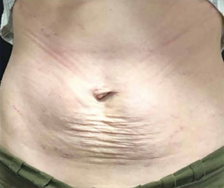 SkinTyte Before & After