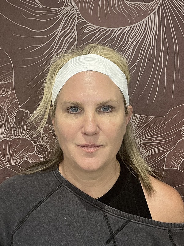 Microneedling Before & After