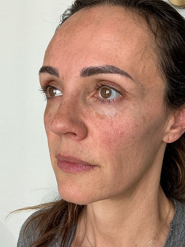 Lip Filler Before & After