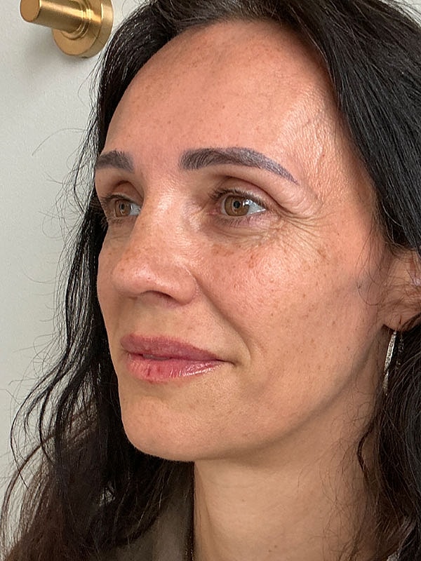 Lip Filler Before & After