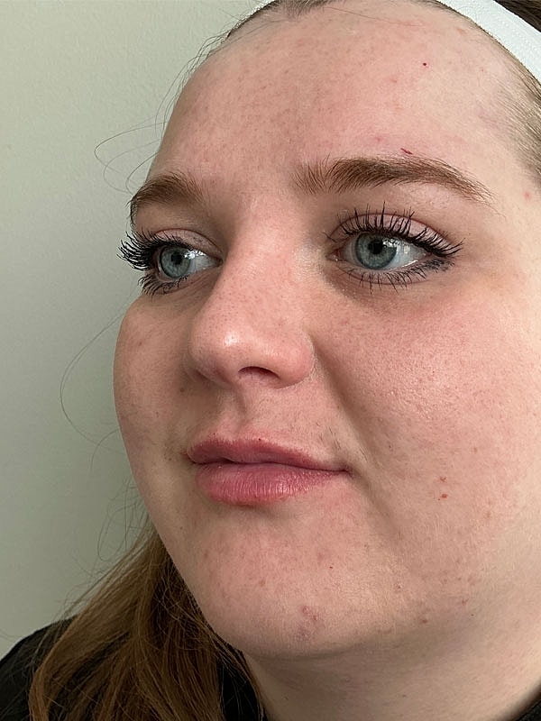 Lip Filler Before & After