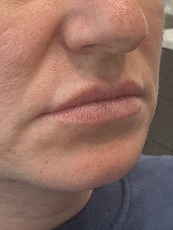 Lip Filler Before & After