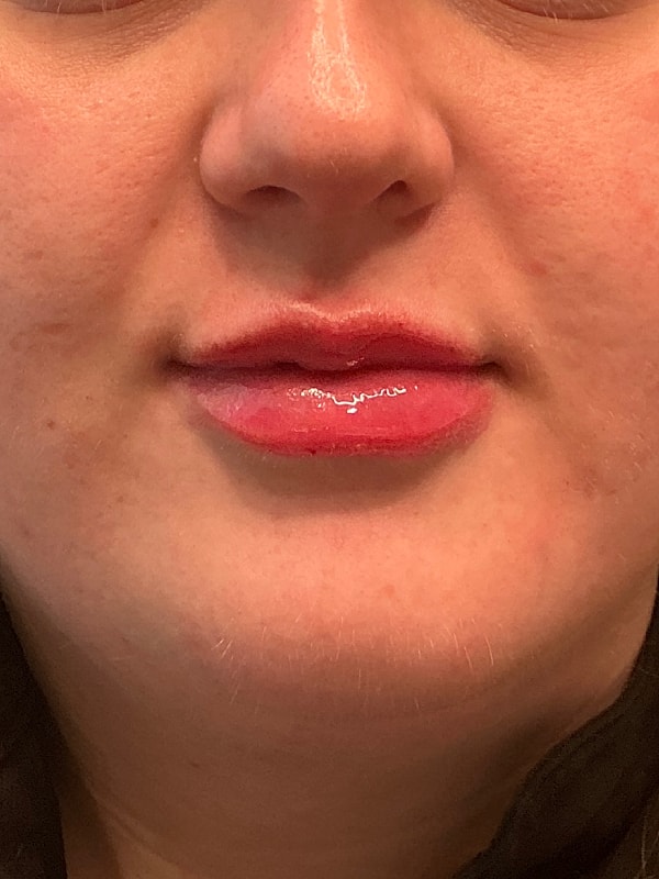 Lip Filler Before & After
