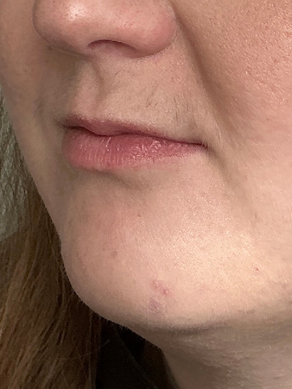 Lip Filler Before & After