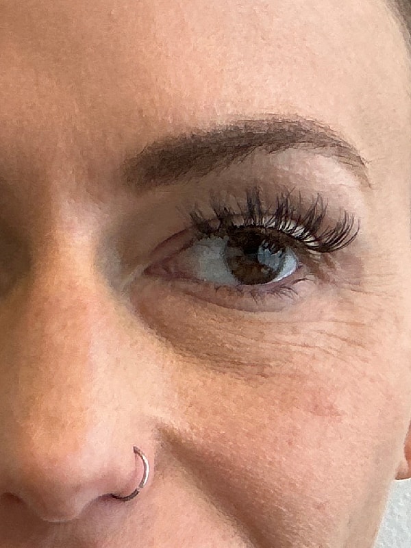 Under Eye Treatment Before & After