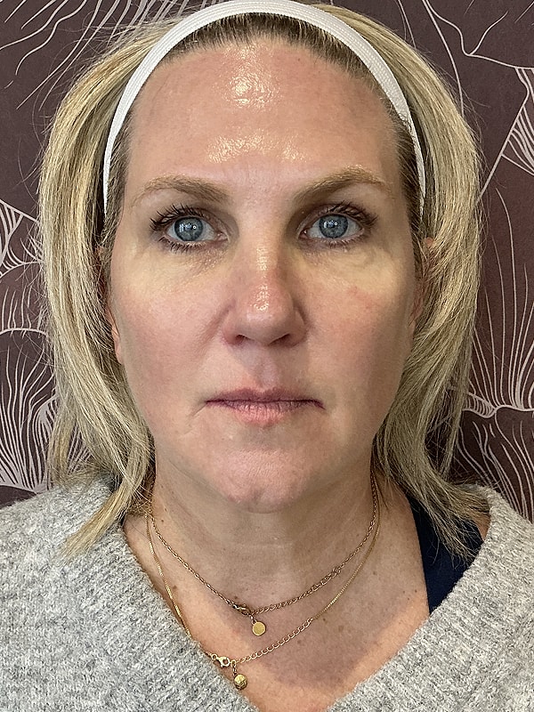 Full Facial Balancing Before & After