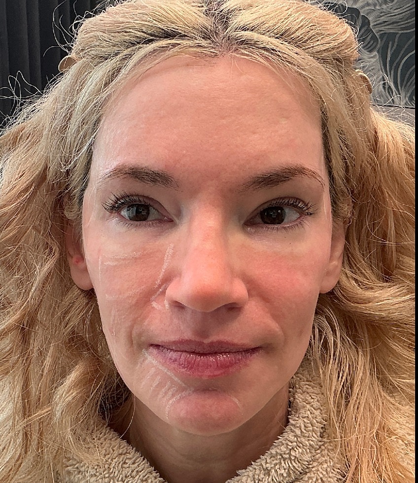 Full Balancing Before & After