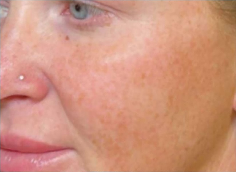 BBL Heroic Before & After