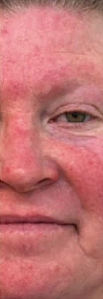 BBL Heroic Before & After