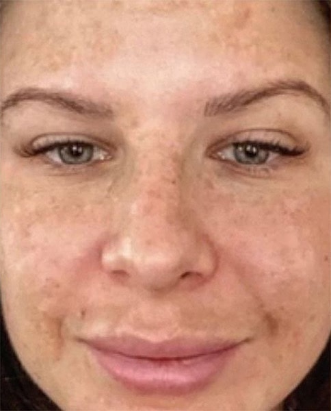 BBL Heroic Before & After