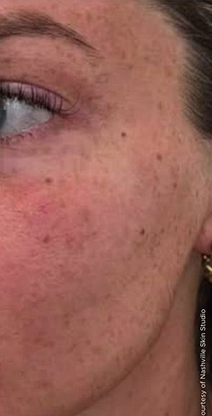 BBL Heroic Before & After