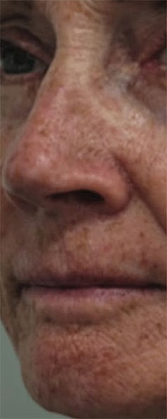 BBL Heroic Before & After