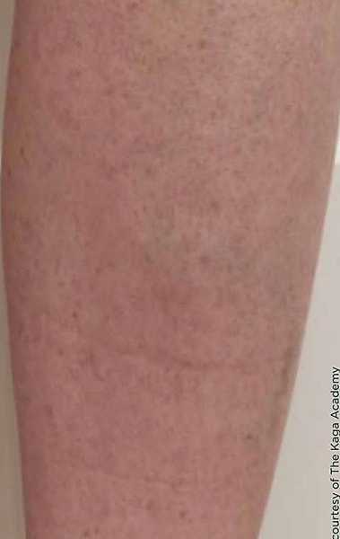 BBL Heroic Before & After