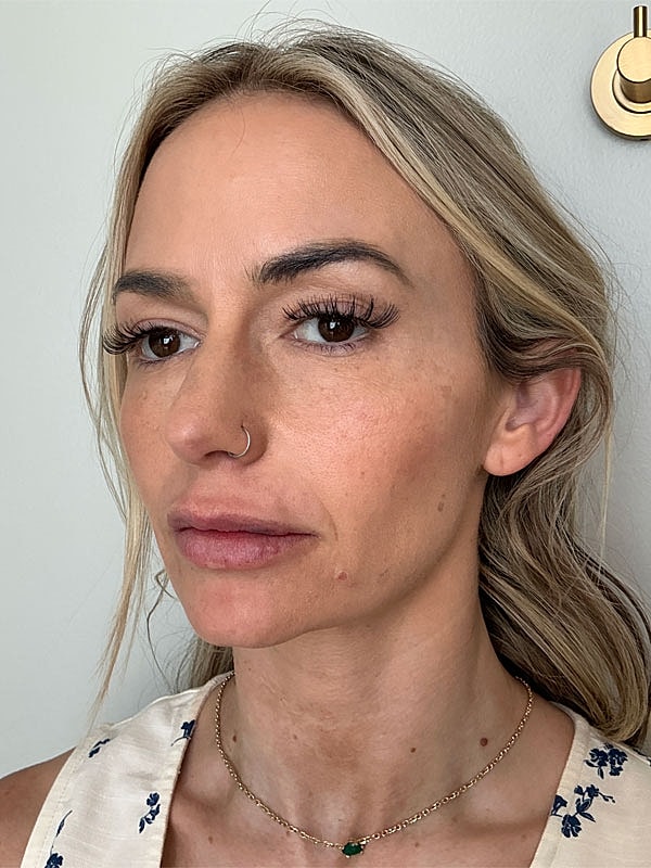 Sculptra Before & After