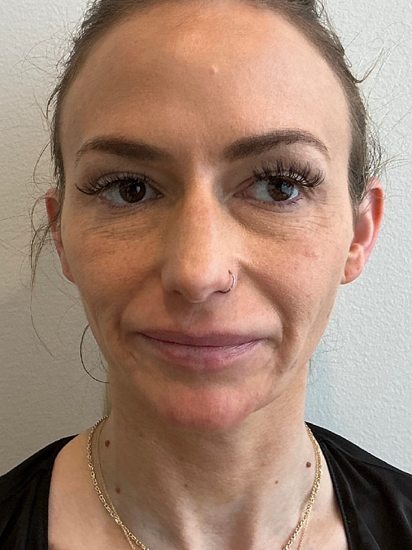 Sculptra Before & After