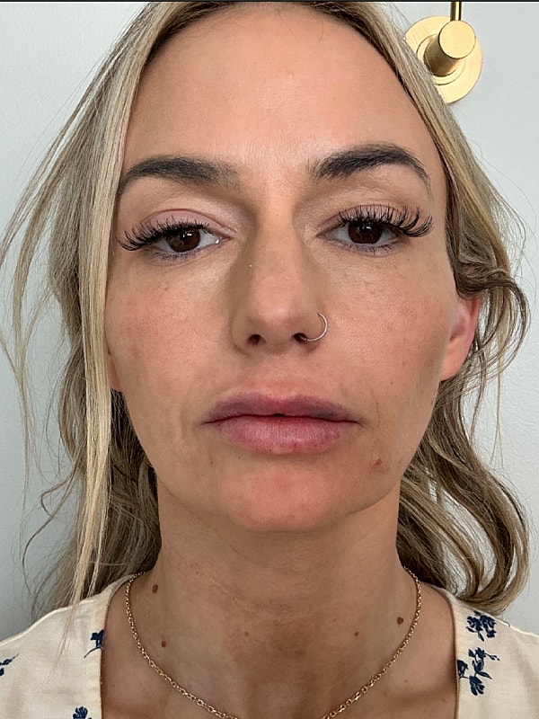 Sculptra Before & After